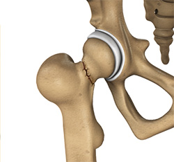 Hip Fracture