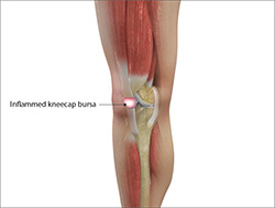 Bursitis