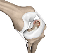 Meniscal Tears