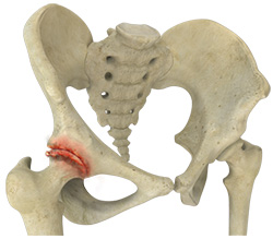 Transient Osteoporosis of the Hip