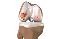 Osteoarthritis