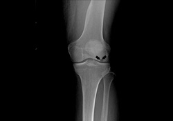 Osteonecrosis of the Knee