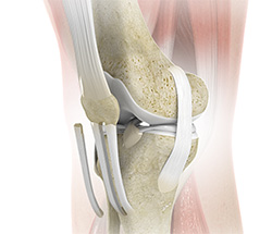 Patella Tendon Rupture