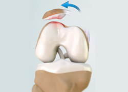 Patellar Dislocation/Patellofemoral Dislocation