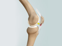 Patellar tendinitis