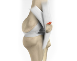 Quadriceps Tendon Rupture