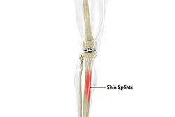 Shin Splints